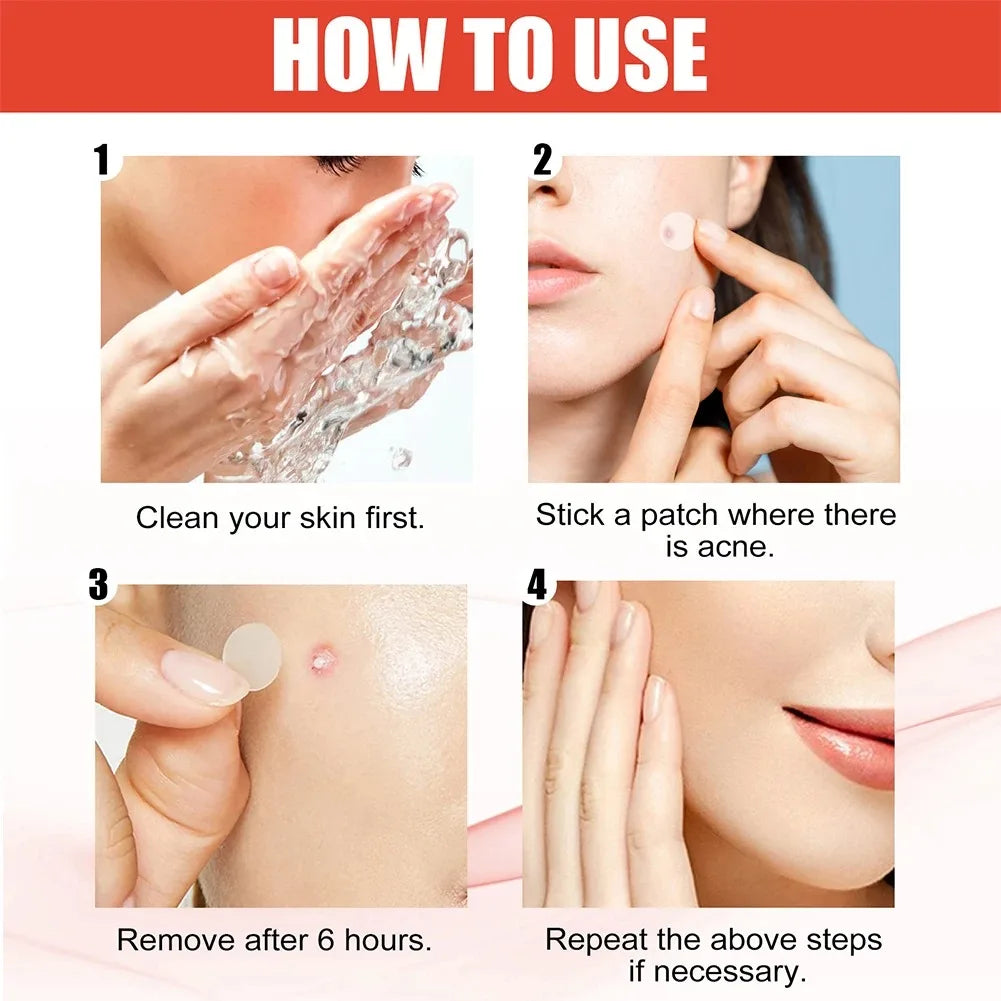 144pcs Acne Patches for Spot Treatment, Invisible Healing Stickers