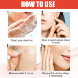 144pcs Acne Patches for Spot Treatment, Invisible Healing Stickers